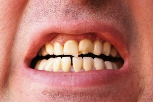 Best BJJ Mouthguard 2022