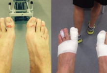 Mat Burn In BJJ: What It Is, How To Prevent It, And How To Treat It
