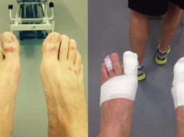 Mat Burn In BJJ: What It Is, How To Prevent It, And How To Treat It